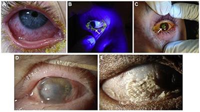 Acute and Chronic Management of Ocular Disease in Stevens Johnson Syndrome/Toxic Epidermal Necrolysis in the USA